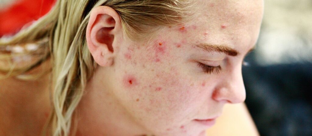 The Basics of Acne and Acne Scarring