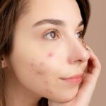 Acne Scar Treatments That Work
