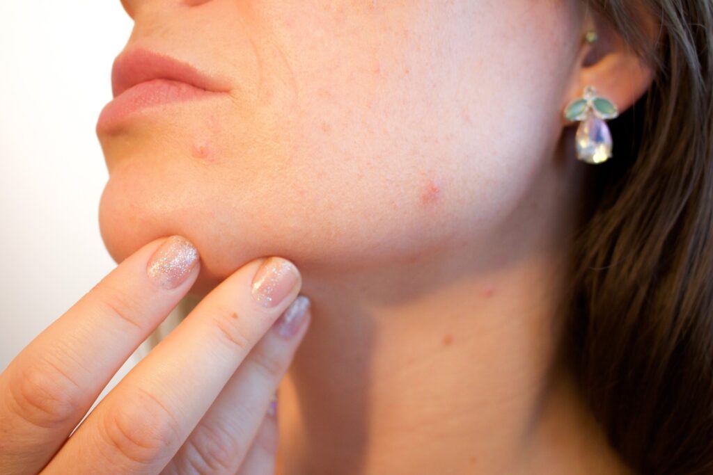 Pimple Popping Can Cause Scarring - Here's What Doctors Recommend Instead