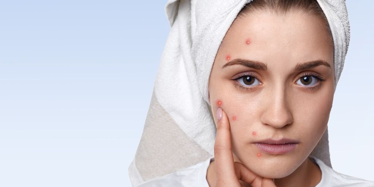 Acne Scar Myths Busted Skin Care Tips Backed by Science to Reduce Scarring